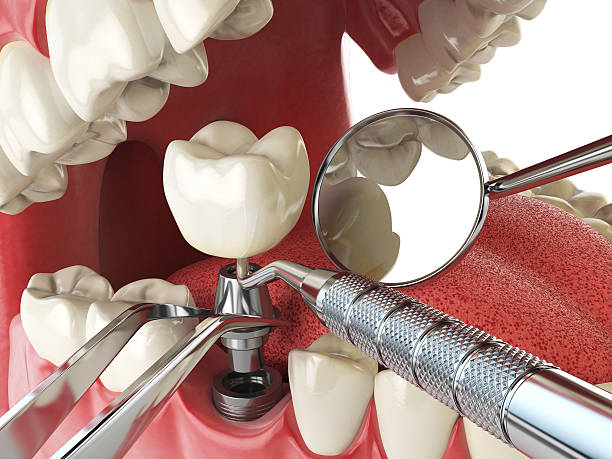 Best Chipped Tooth Repair Near Me  in Kingston, NY